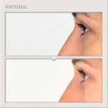 Resultados de blefaroplastia de párpado inferior antes y después en Sienna Clinic, rejuvenecimiento ocular