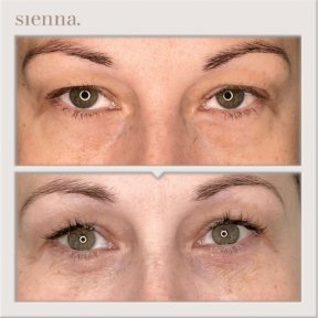 Resultados de blefaroplastia de párpado inferior antes y después en Sienna Clinic, menos bolsas