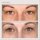 Resultados de blefaroplastia de párpado inferior antes y después en Sienna Clinic, menos bolsas
