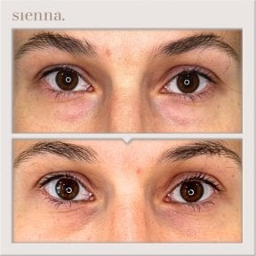 Resultados de blefaroplastia de párpado inferior antes y después en Sienna Clinic, menos bolsas