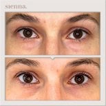 Resultados de blefaroplastia de párpado inferior antes y después en Sienna Clinic, menos bolsas