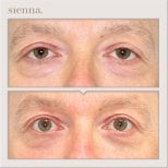 Resultados de blefaroplastia de párpado inferior antes y después en Sienna Clinic, menos bolsas