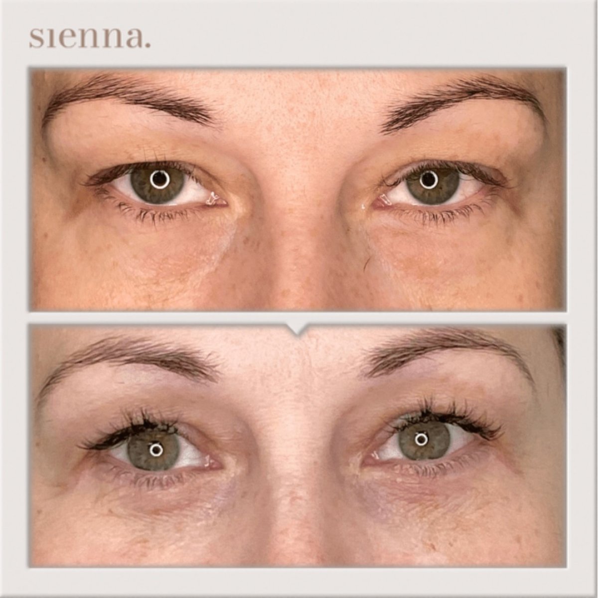 Resultados de blefaroplastia de párpado inferior antes y después en Sienna Clinic, menos bolsas