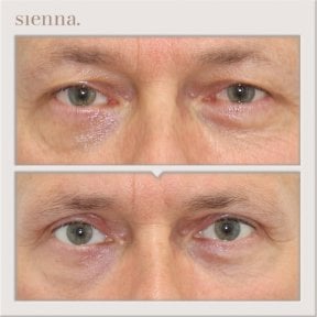 Resultados de blefaroplastia de párpado inferior antes y después en Sienna Clinic, menos bolsas