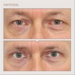 Resultados de blefaroplastia de párpado inferior antes y después en Sienna Clinic, menos bolsas