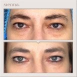 Resultados de blefaroplastia de párpado inferior antes y después en Sienna Clinic, menos bolsas