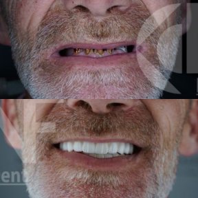 before-after photo immediate-load-all-on-6-dental-implants