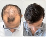 Résultats avant et après greffe de cheveux FUE à Hisar Hospital Intercontinental, ligne capillaire restaurée