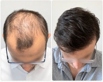 Resultados antes y después de trasplante capilar FUE en Hisar Hospital Intercontinental, línea restaurada