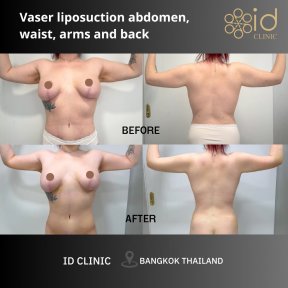 before-after photo 360-liposuction