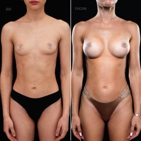 before-after photo breast-augmentation