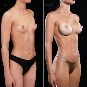 before-after photo breast-augmentation