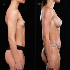 before-after photo breast-augmentation