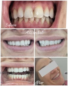 before-after photo rekonstrukciya-zubov-s-ispolzovaniem-kompozitov-bonding
