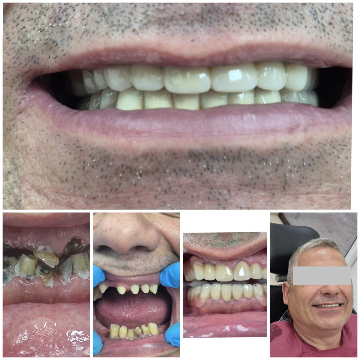 نتائج قبل وبعد تركيب تيجان الأسنان في AllDental – ابتسامة مستعادة