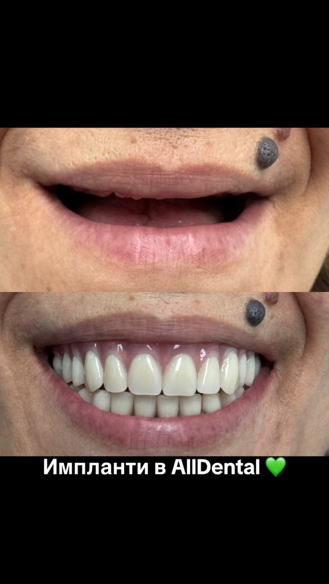 before-after photo