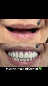 before-after photo all-on-4-dental-implants