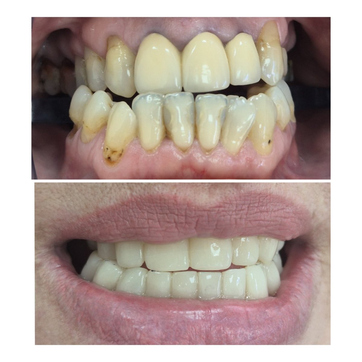 قبل وبعد تركيب تيجان الأسنان في AllDental – ابتسامة محسنة ونتيجة أسنان أكثر بياضًا