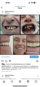 before-after photo all-on-4-dental-implants