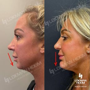 before-after photo rhinoplasty-nose-job