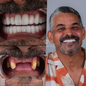 before-after photo all-on-4-dental-implants