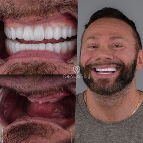 before-after photo all-on-4-dental-implants