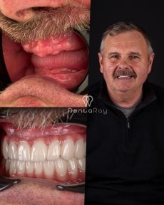 before-after photo all-on-4-dental-implants