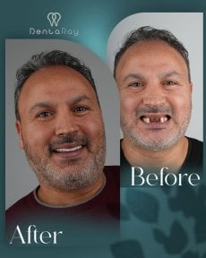 before-after photo all-on-4-dental-implants