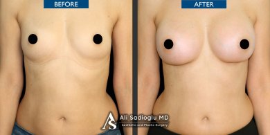 Resultados de aumento de senos antes y después en Dr. Safa Manav Clinic, mayor volumen mamario