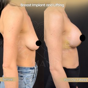 Resultados antes y después de aumento y levantamiento de senos en Dr. Safa Manav Clinic