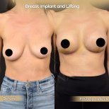 Resultados antes y después de aumento y levantamiento de senos en Dr. Safa Manav Clinic