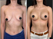 Resultados antes y después de aumento de senos en Dr. Safa Manav Clinic, forma mejorada