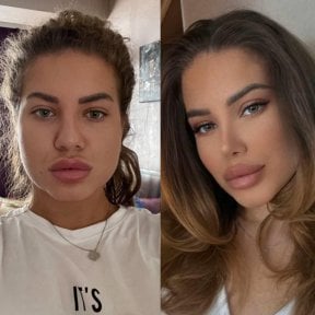 Resultados de rinoplastia antes y después en Dr. Safa Manav Clinic, remodelación de la nariz