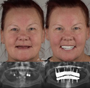 Результаты до и после имплантации зубов в Dr. Birkan Dental Clinic, полная реставрация