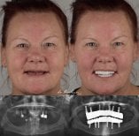 Результаты до и после имплантации зубов в Dr. Birkan Dental Clinic, полная реставрация