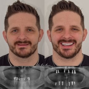 Результаты имплантации зубов до и после в Dr. Birkan Dental Clinic – восстановленная улыбка