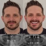 Результаты имплантации зубов до и после в Dr. Birkan Dental Clinic – восстановленная улыбка
