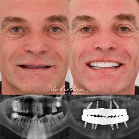 Результаты имплантации зубов до и после в Dr. Birkan Dental Clinic – восстановление улыбки