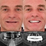 Результаты имплантации зубов до и после в Dr. Birkan Dental Clinic – восстановление улыбки