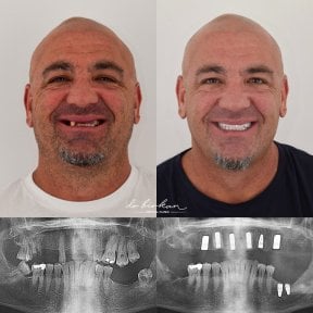 Результаты до и после имплантации зубов в Dr. Birkan Dental Clinic с улучшенной улыбкой
