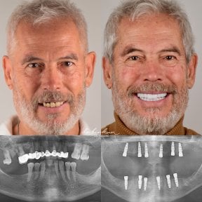 Результаты до и после имплантации зубов в Dr. Birkan Dental Clinic, улучшенная улыбка и рентген