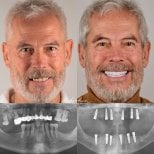 Результаты до и после имплантации зубов в Dr. Birkan Dental Clinic, улучшенная улыбка и рентген