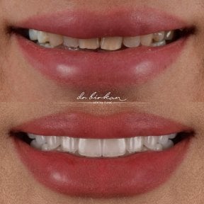 Результат до и после виниров в Dr. Birkan Dental Clinic – улыбка с белыми зубами