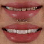 Результат до и после виниров в Dr. Birkan Dental Clinic – улыбка с белыми зубами