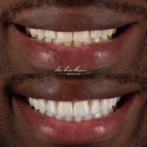 Результат до и после виниров в Dr. Birkan Dental Clinic – улучшение эстетики улыбки