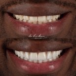 Результат до и после виниров в Dr. Birkan Dental Clinic – улучшение эстетики улыбки