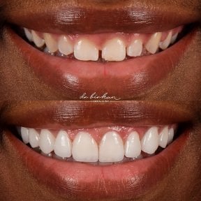 Результат до и после виниров в Dr. Birkan Dental Clinic – естественное преображение улыбки