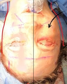 before-after photo deep-plane-facelift