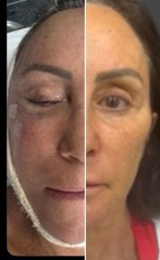 before-after photo deep-plane-facelift