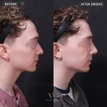 Resultados de rinoplastia antes y después en VG Plastic Surgery, perfil nasal mejorado tras 2 semanas